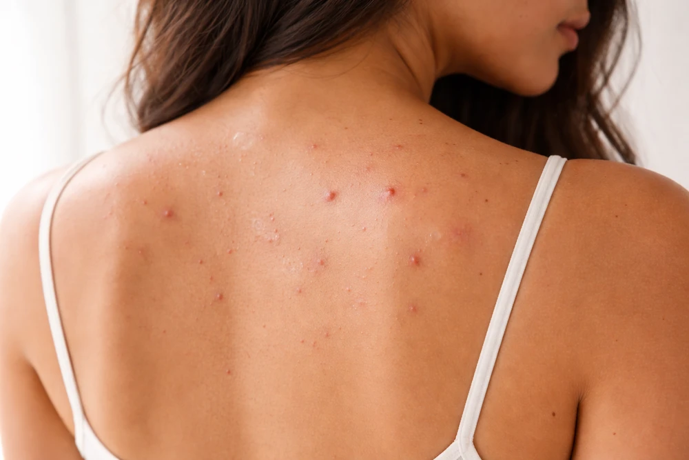 mujer con bacne o acné corporal en la espalda