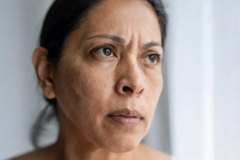 mujer con manchas hormonales y melasma en mejillas y frente